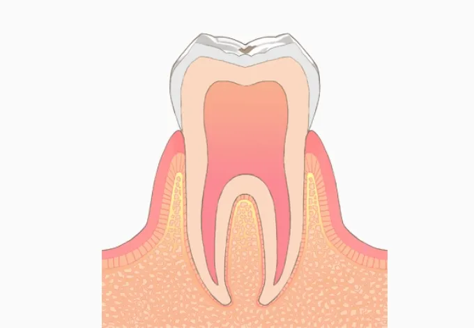C0＝初期むし歯