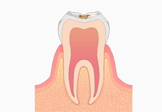 C1＝エナメル質のむし歯​