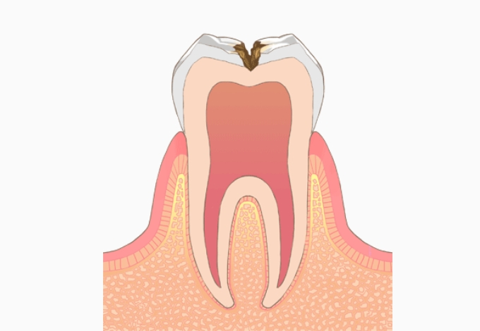 C2＝象牙質のむし歯​