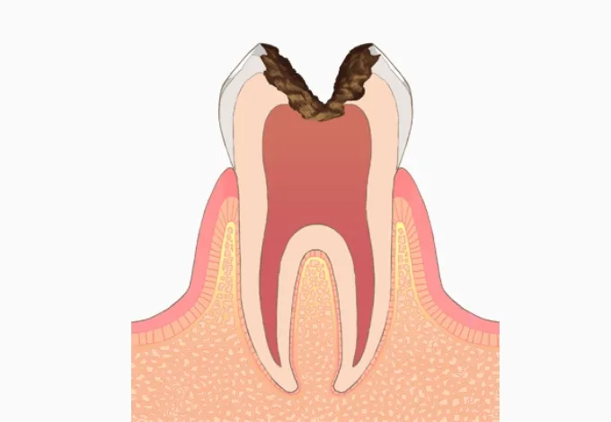 C3＝神経まで達したむし歯
