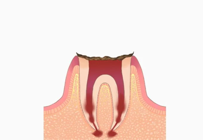 C4＝歯根まで達したむし歯